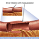 Invaginazione intestinale - foto