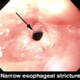 Estenosis esofagica - imagenes