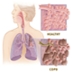 Maladie pulmonaire obstructive chronique (MPOC ) - photos