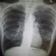 Maladie pulmonaire obstructive chronique (MPOC ) - photos