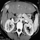 La fibrosis hepatica congenita - imagenes