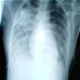 Syndrome respiratoire aigu severe ( SRAS ) - photos