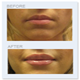 Lippenvergrößerung - Bilder