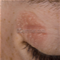 Eczema Paupières - photos
