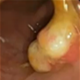 Рак на дебелото черво - снимки